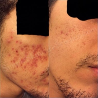 Niche Utama 2 How To Get Rid Of Acne Scars Explained ( Studies)  PIE Vs